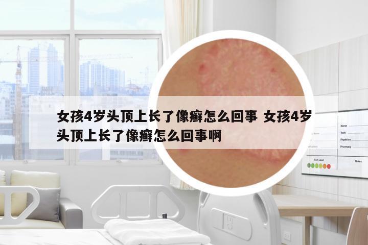 女孩4歲頭頂上長(zhǎng)了像癬怎么回事 女孩4歲頭頂上長(zhǎng)了像癬怎么回事啊