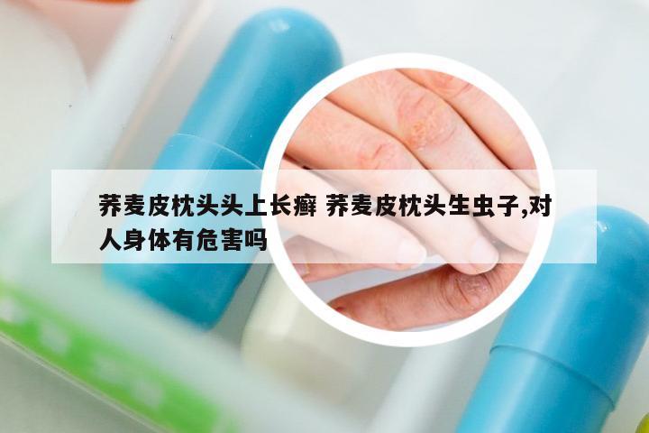 蕎麥皮枕頭頭上長癬 蕎麥皮枕頭生蟲子,對人身體有危害嗎
