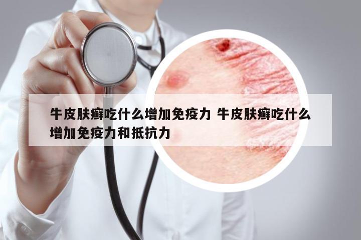 牛皮膚癬吃什么增加免疫力 牛皮膚癬吃什么增加免疫力和抵抗力