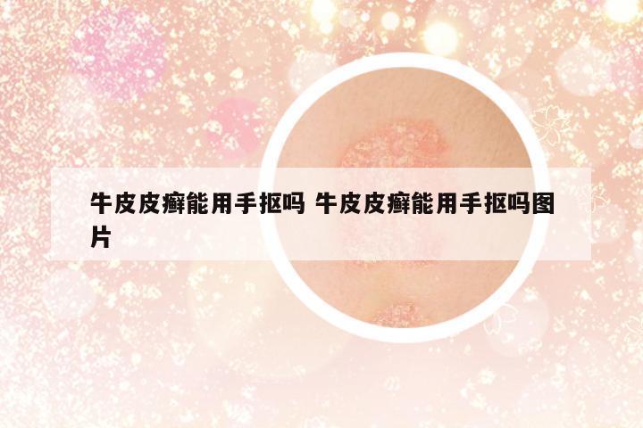 牛皮皮癬能用手摳嗎 牛皮皮癬能用手摳嗎圖片
