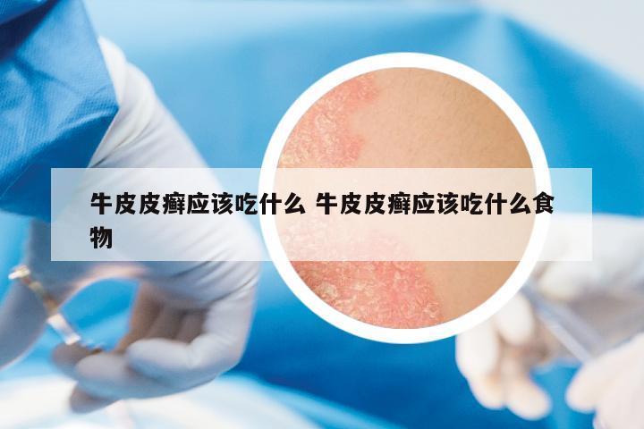 牛皮皮癬應該吃什么 牛皮皮癬應該吃什么食物