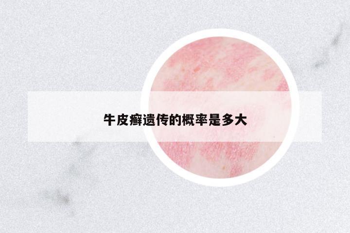 牛皮癬遺傳的概率是多大