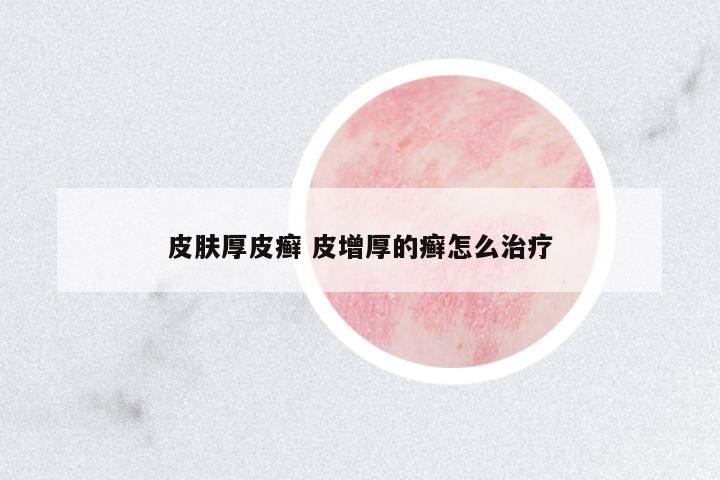 皮膚厚皮癬 皮增厚的癬怎么治療