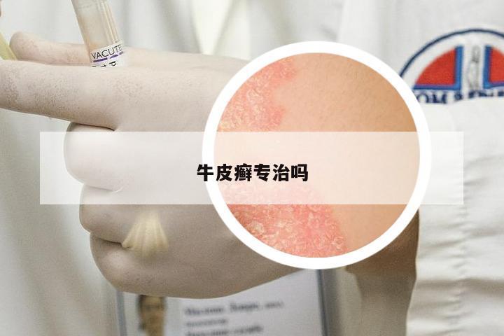 牛皮癬專治嗎