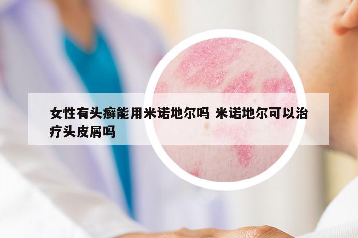 女性有頭癬能用米諾地爾嗎 米諾地爾可以治療頭皮屑嗎