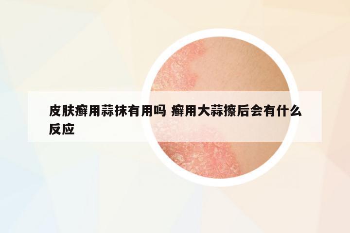 皮膚癬用蒜抹有用嗎 癬用大蒜擦后會有什么反應(yīng)