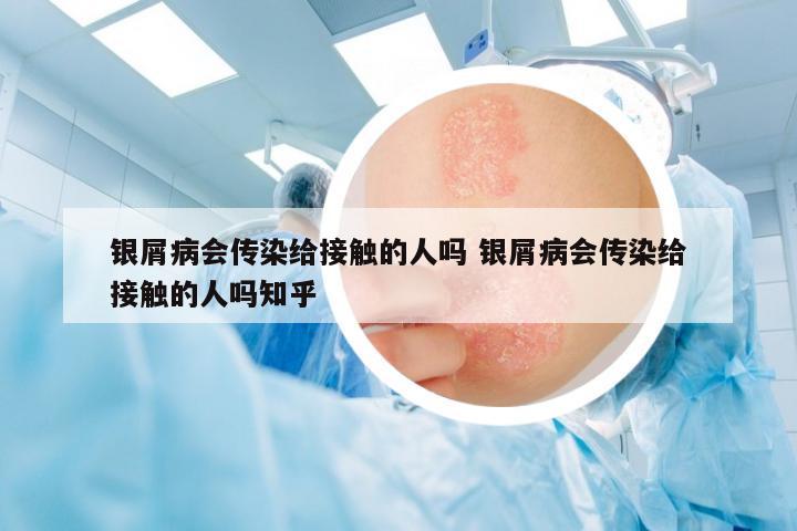 銀屑病會傳染給接觸的人嗎 銀屑病會傳染給接觸的人嗎知乎