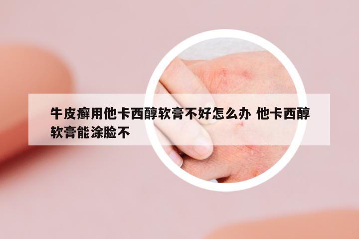 牛皮癬用他卡西醇軟膏不好怎么辦 他卡西醇軟膏能涂臉不