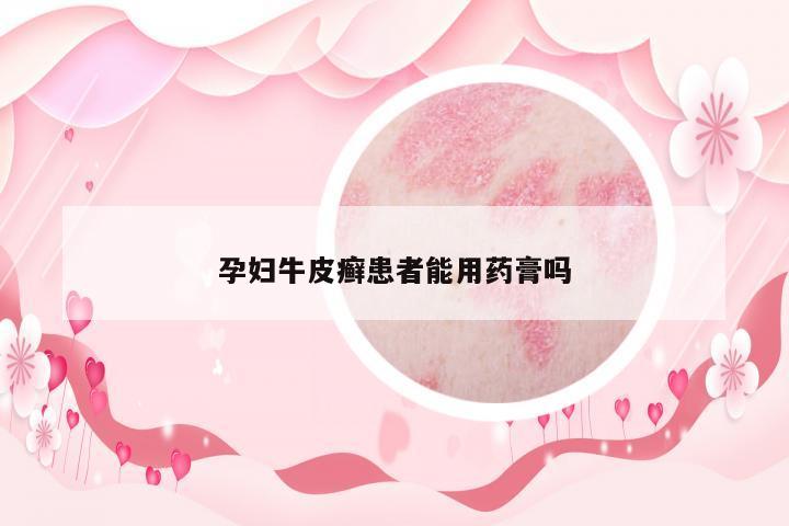 孕婦牛皮癬患者能用藥膏嗎