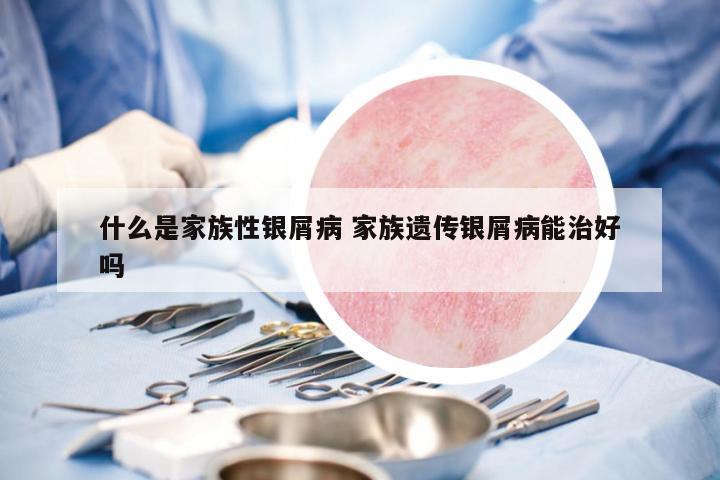 什么是家族性銀屑病 家族遺傳銀屑病能治好嗎
