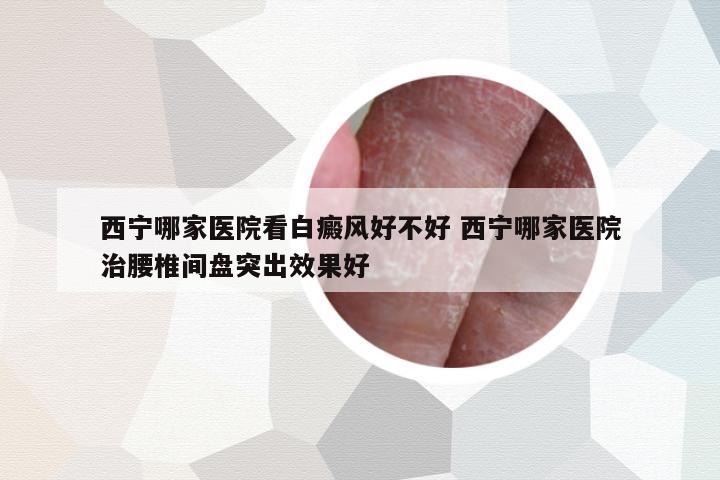 西寧哪家醫(yī)院看白癜風(fēng)好不好 西寧哪家醫(yī)院治腰椎間盤突出效果好