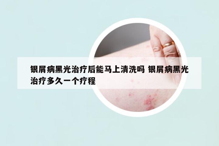 銀屑病黑光治療后能馬上清洗嗎 銀屑病黑光治療多久一個(gè)療程