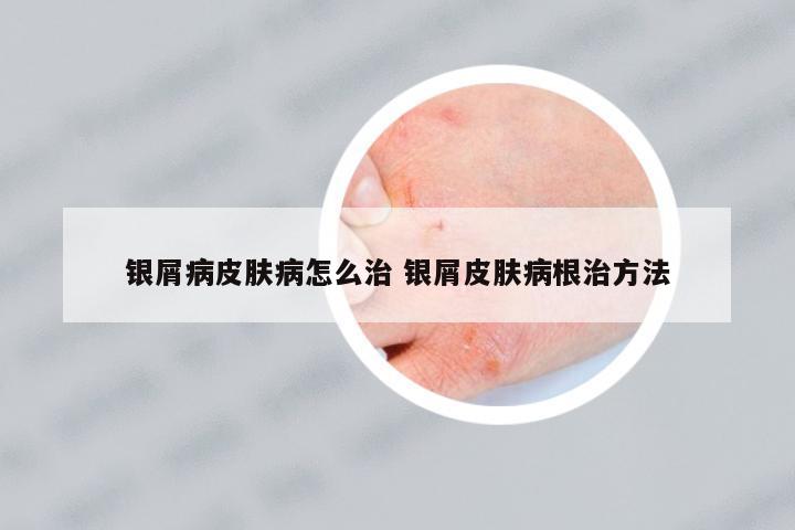 銀屑病皮膚病怎么治 銀屑皮膚病根治方法