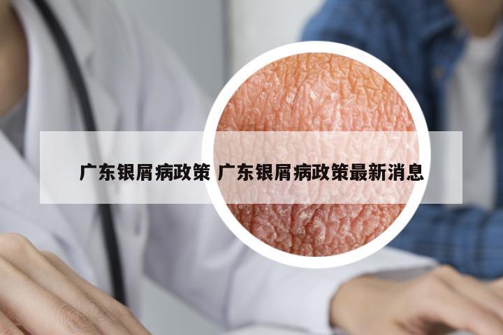 廣東銀屑病政策 廣東銀屑病政策最新消息