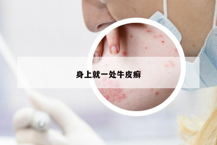 身上就一處牛皮癬