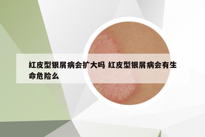 紅皮型銀屑病會(huì)擴(kuò)大嗎 紅皮型銀屑病會(huì)有生命危險(xiǎn)么