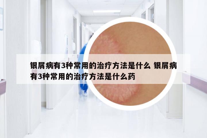 銀屑病有3種常用的治療方法是什么 銀屑病有3種常用的治療方法是什么藥