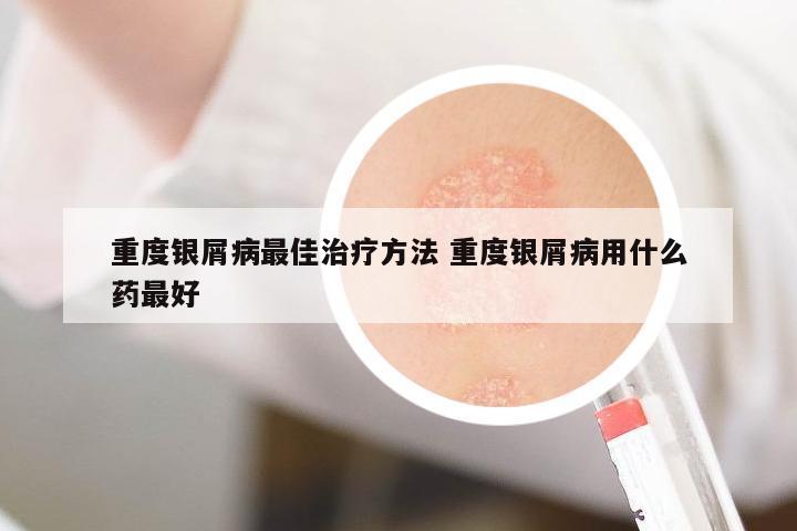 重度銀屑病最佳治療方法 重度銀屑病用什么藥最好