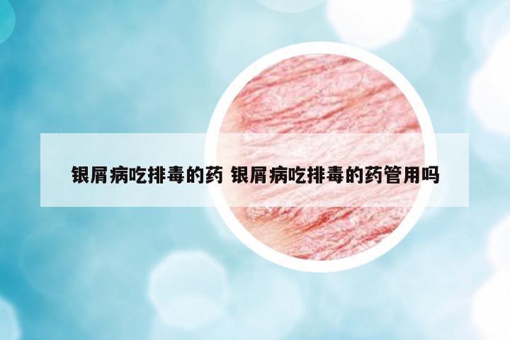 銀屑病吃排毒的藥 銀屑病吃排毒的藥管用嗎