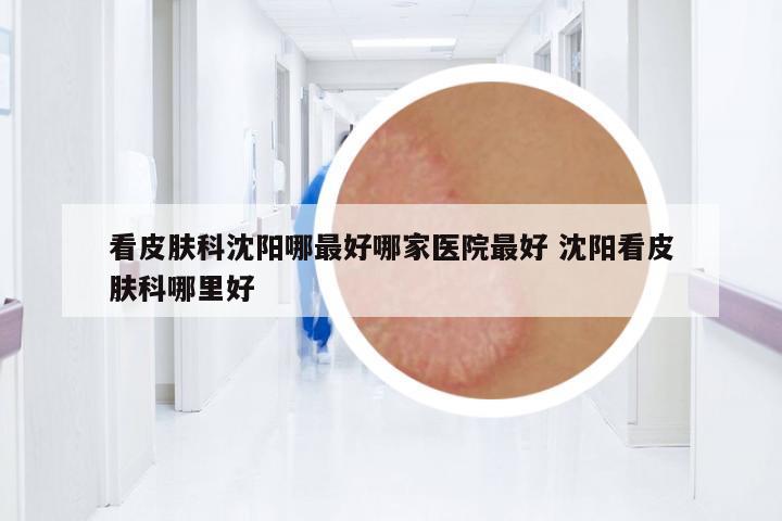 看皮膚科沈陽哪最好哪家醫(yī)院最好 沈陽看皮膚科哪里好