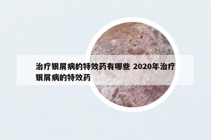 治療銀屑病的特效藥有哪些 2020年治療銀屑病的特效藥
