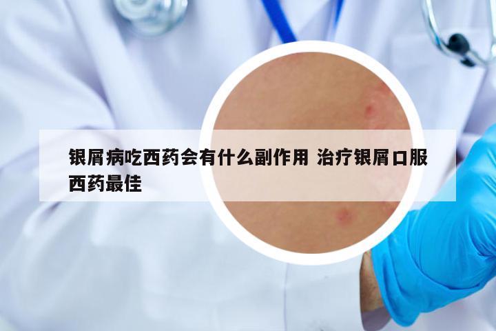 銀屑病吃西藥會(huì)有什么副作用 治療銀屑口服西藥最佳