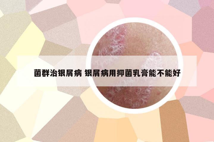 菌群治銀屑病 銀屑病用抑菌乳膏能不能好