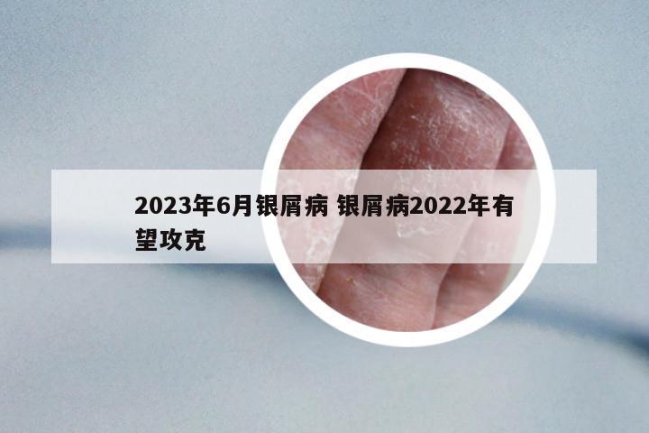 2023年6月銀屑病 銀屑病2022年有望攻克