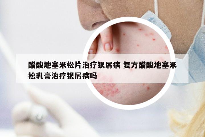 醋酸地塞米松片治療銀屑病 復(fù)方醋酸地塞米松乳膏治療銀屑病嗎