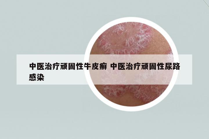 中醫(yī)治療頑固性牛皮癬 中醫(yī)治療頑固性尿路感染