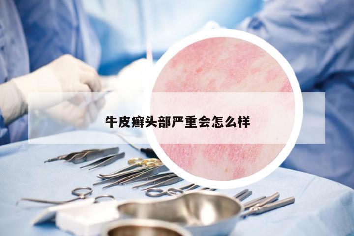 牛皮癬頭部嚴重會怎么樣