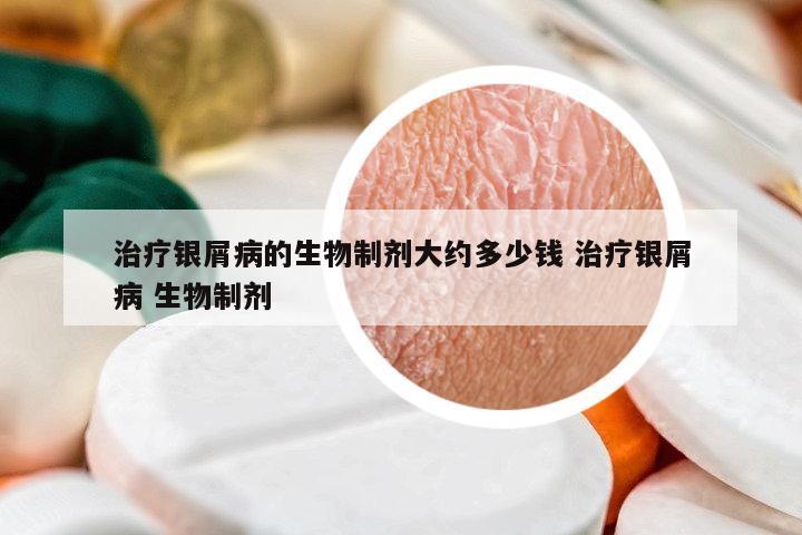 治療銀屑病的生物制劑大約多少錢 治療銀屑病 生物制劑