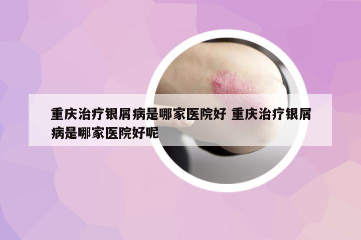 重慶治療銀屑病是哪家醫(yī)院好 重慶治療銀屑病是哪家醫(yī)院好呢