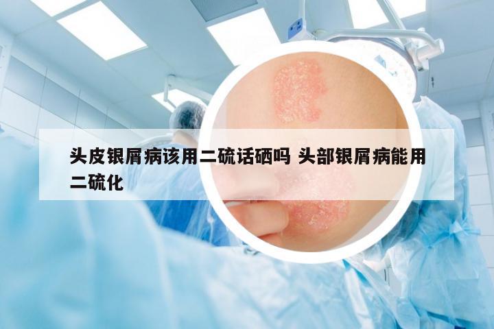頭皮銀屑病該用二硫話硒嗎 頭部銀屑病能用二硫化