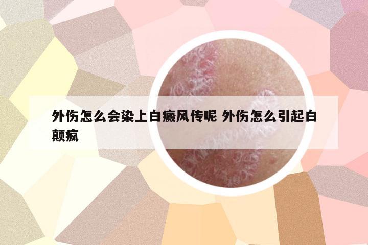 外傷怎么會染上白癜風傳呢 外傷怎么引起白顛瘋