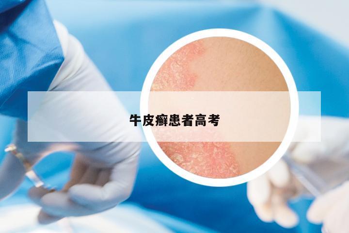 牛皮癬患者高考