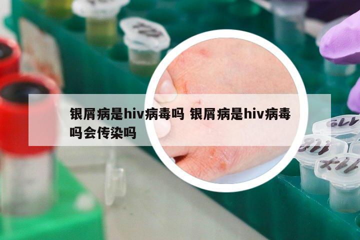 銀屑病是hiv病毒嗎 銀屑病是hiv病毒嗎會(huì)傳染嗎