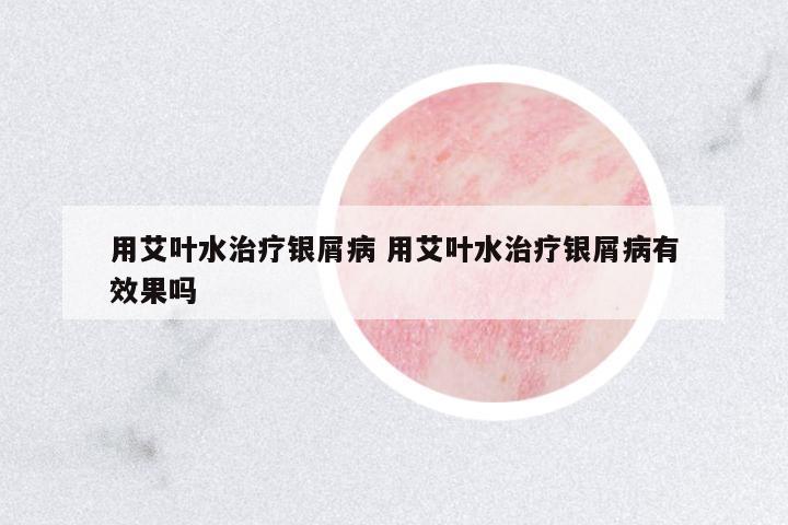 用艾葉水治療銀屑病 用艾葉水治療銀屑病有效果嗎