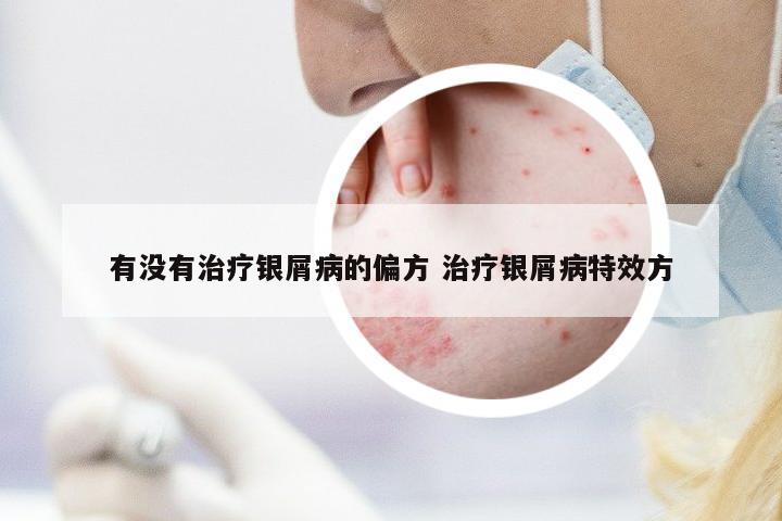 有沒有治療銀屑病的偏方 治療銀屑病特效方