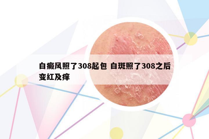 白癜風(fēng)照了308起包 白斑照了308之后變紅及癢