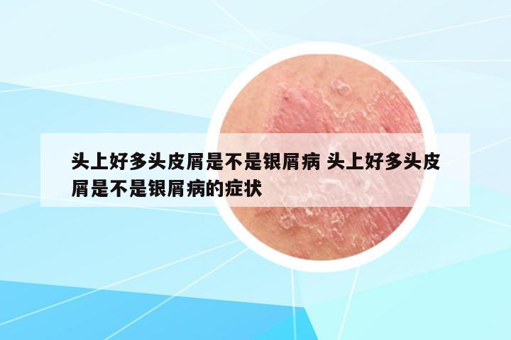 頭上好多頭皮屑是不是銀屑病 頭上好多頭皮屑是不是銀屑病的癥狀