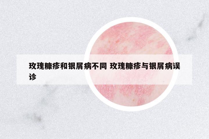 玫瑰糠疹和銀屑病不同 玫瑰糠疹與銀屑病誤診