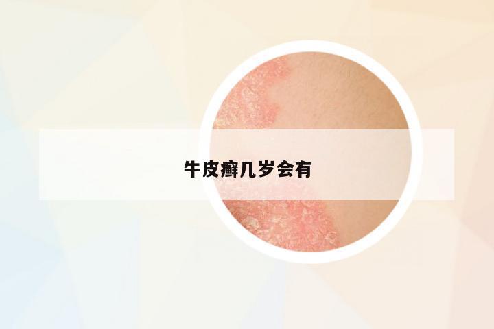牛皮癬幾歲會有