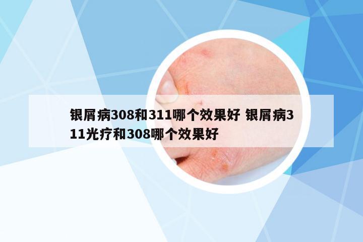 銀屑病308和311哪個(gè)效果好 銀屑病311光療和308哪個(gè)效果好