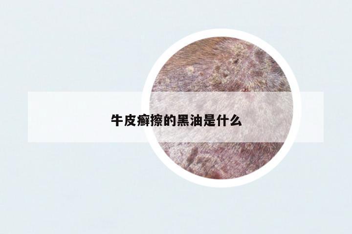 牛皮癬擦的黑油是什么