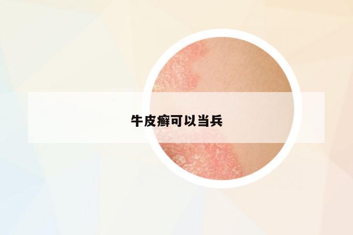 牛皮癬可以當兵