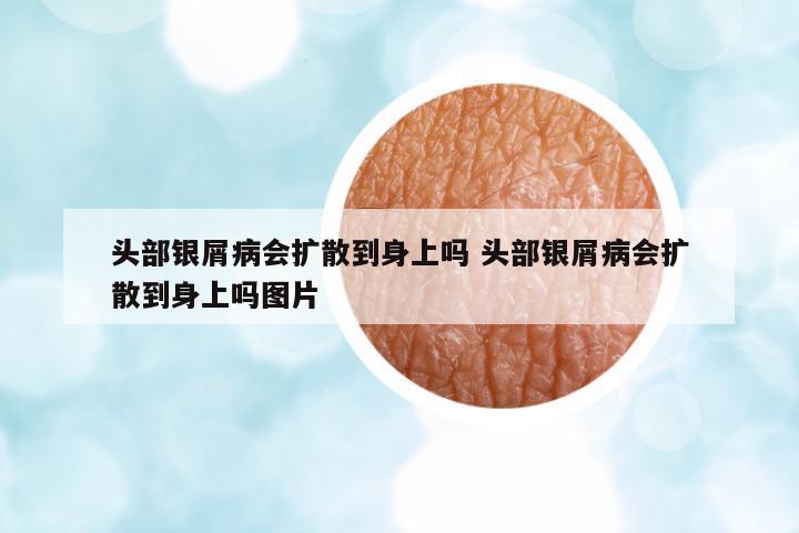頭部銀屑病會(huì)擴(kuò)散到身上嗎 頭部銀屑病會(huì)擴(kuò)散到身上嗎圖片
