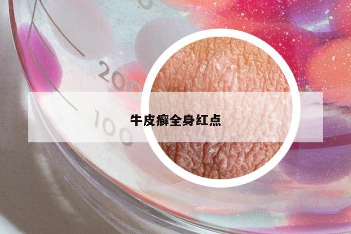 牛皮癬全身紅點(diǎn)