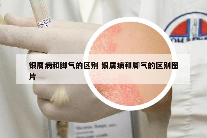 銀屑病和腳氣的區(qū)別 銀屑病和腳氣的區(qū)別圖片