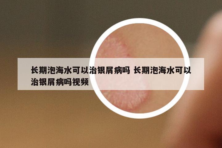 長期泡海水可以治銀屑病嗎 長期泡海水可以治銀屑病嗎視頻